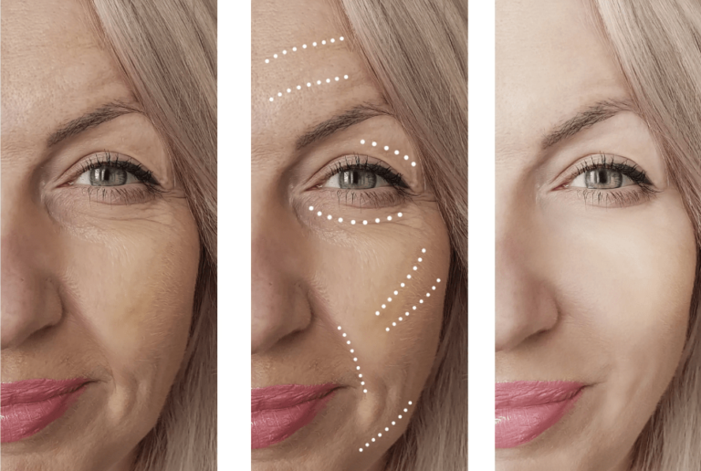 Proceso de rejuvenecimiento facial